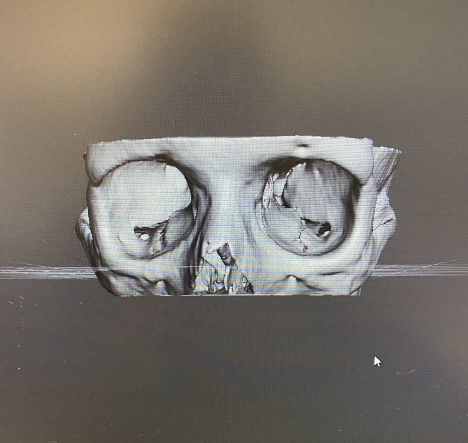 3d_maranon's tweet photo. 3D model created for planification of a reconstruction of an orbital fracture which occurs when one or more bones around the eyeball break. https://t.co/HxIPOJO8k2