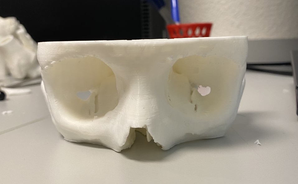 3d_maranon's tweet photo. 3D model created for planification of a reconstruction of an orbital fracture which occurs when one or more bones around the eyeball break. https://t.co/HxIPOJO8k2
