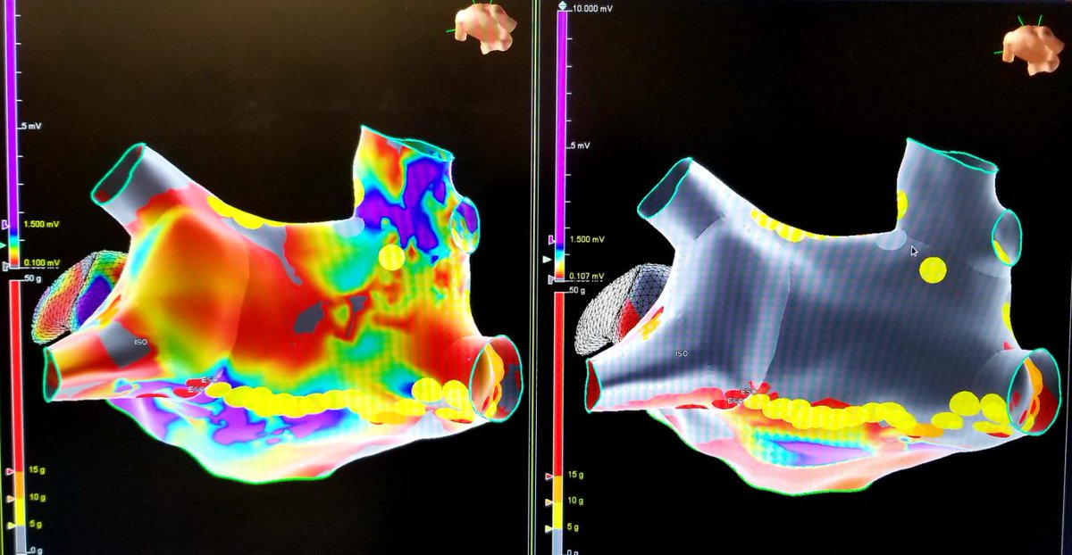 ThomasMeade15's tweet photo. PVI with roof &amp; inferoposterior linear lesions case with posterior wall isolation before and after voltage. We avoided posterior wall near left pulmonary veins due to esophagus. We usually ablate posterior wall near veins but was isolated after linear lesions. I https://t.co/OXUY8pdhnd