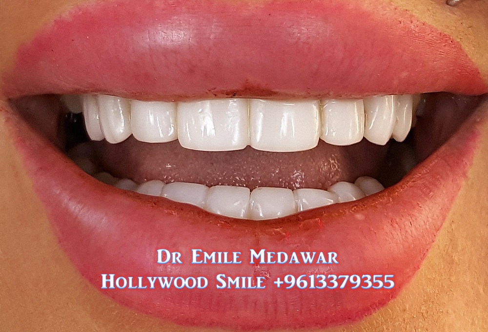 HildaS63868285's tweet photo. #DazzlingSmile #GreatDentalVeneers #BrightTeeth
Dr Emile Medawar #CosmeticDentist #DentalImplantsSurgeon #Lebanon #Beirut #SinelFil +961 3 379355
#VeneersCost #VeneersPrice #porcelainveneers #CompositeVeneers #DentalImplants
emile_medawar@hotmail.com
https://t.co/84RXqneQDR https://t.co/1PF79ZWoXD
