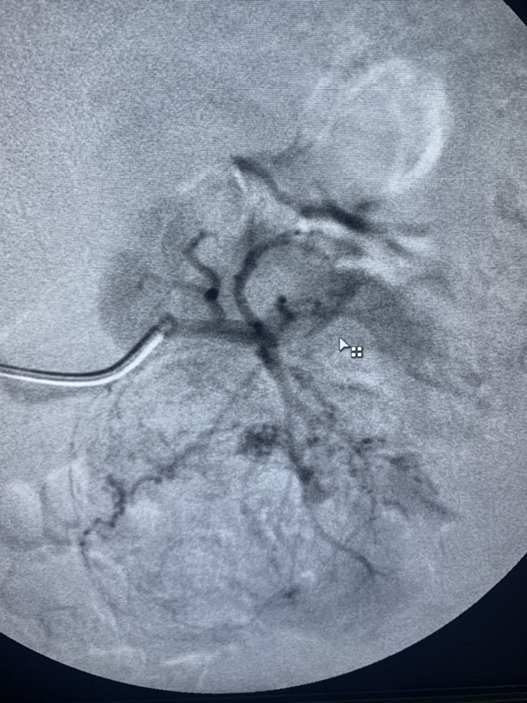 JasperRad's tweet photo. First renal artery embolisation for an Angiomyolipoma https://t.co/rLLpxKWwpU