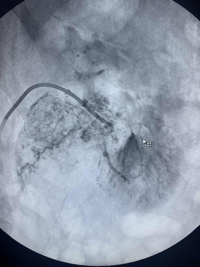 JasperRad's tweet photo. First renal artery embolisation for an Angiomyolipoma https://t.co/rLLpxKWwpU