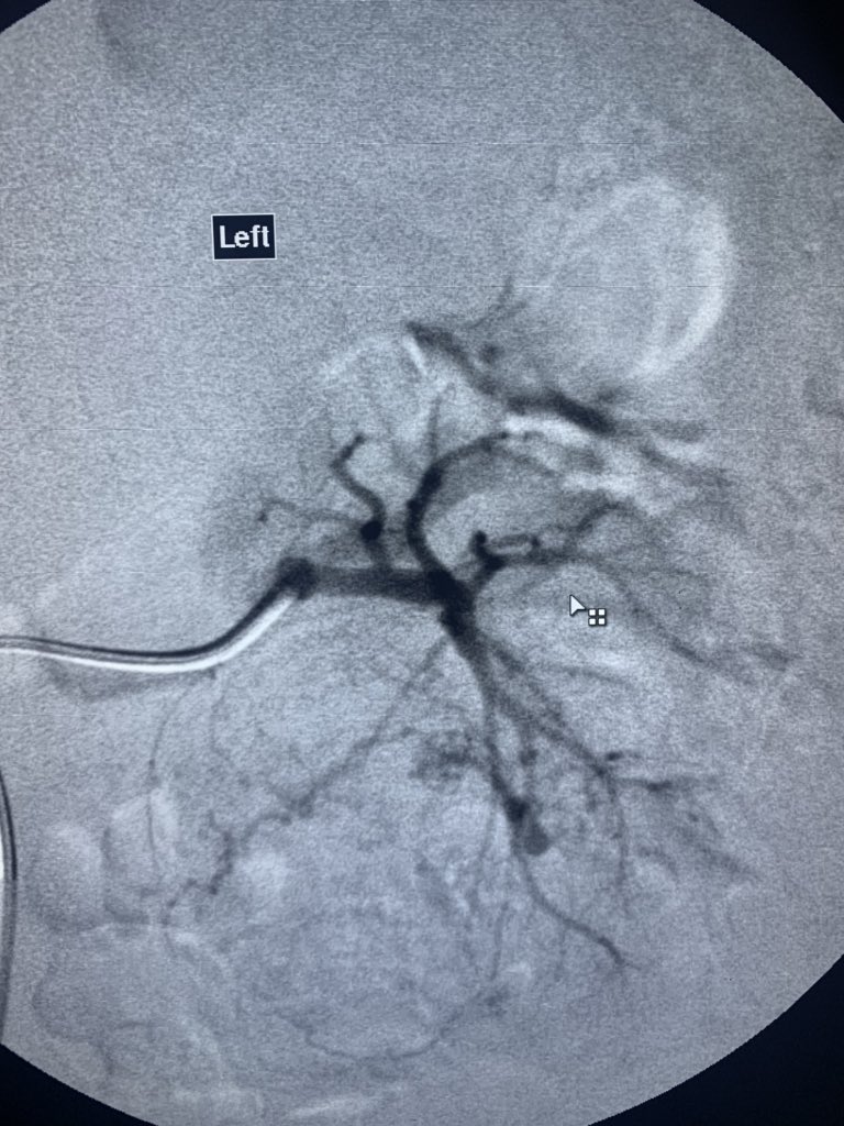 JasperRad's tweet photo. First renal artery embolisation for an Angiomyolipoma https://t.co/rLLpxKWwpU