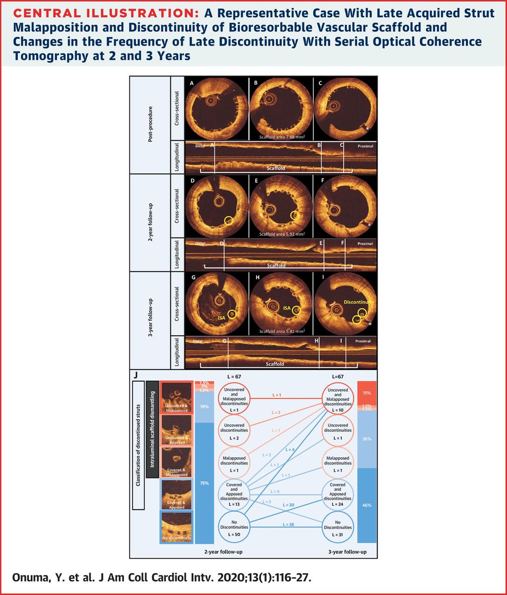 JACC Journals (@jaccjournals) on Twitter photo Serial OCT imaging post-#PCI shows new occurrence of intraluminal dismantling between two and three years during bioresorbable vascular scaffold implantation! bit.ly/2QWt65e #JACCINT <a href="/GreggWStone/">Gregg W. Stone MD</a> <a href="/PopmaJeffrey/">Jeffrey Popma</a> Serial OCT imaging post-#PCI shows new occurrence of intraluminal dismantling between two and three years during bioresorbable vascular scaffold implantation! bit.ly/2QWt65e #JACCINT <a href="/GreggWStone/">Gregg W. Stone MD</a> <a href="/PopmaJeffrey/">Jeffrey Popma</a>
