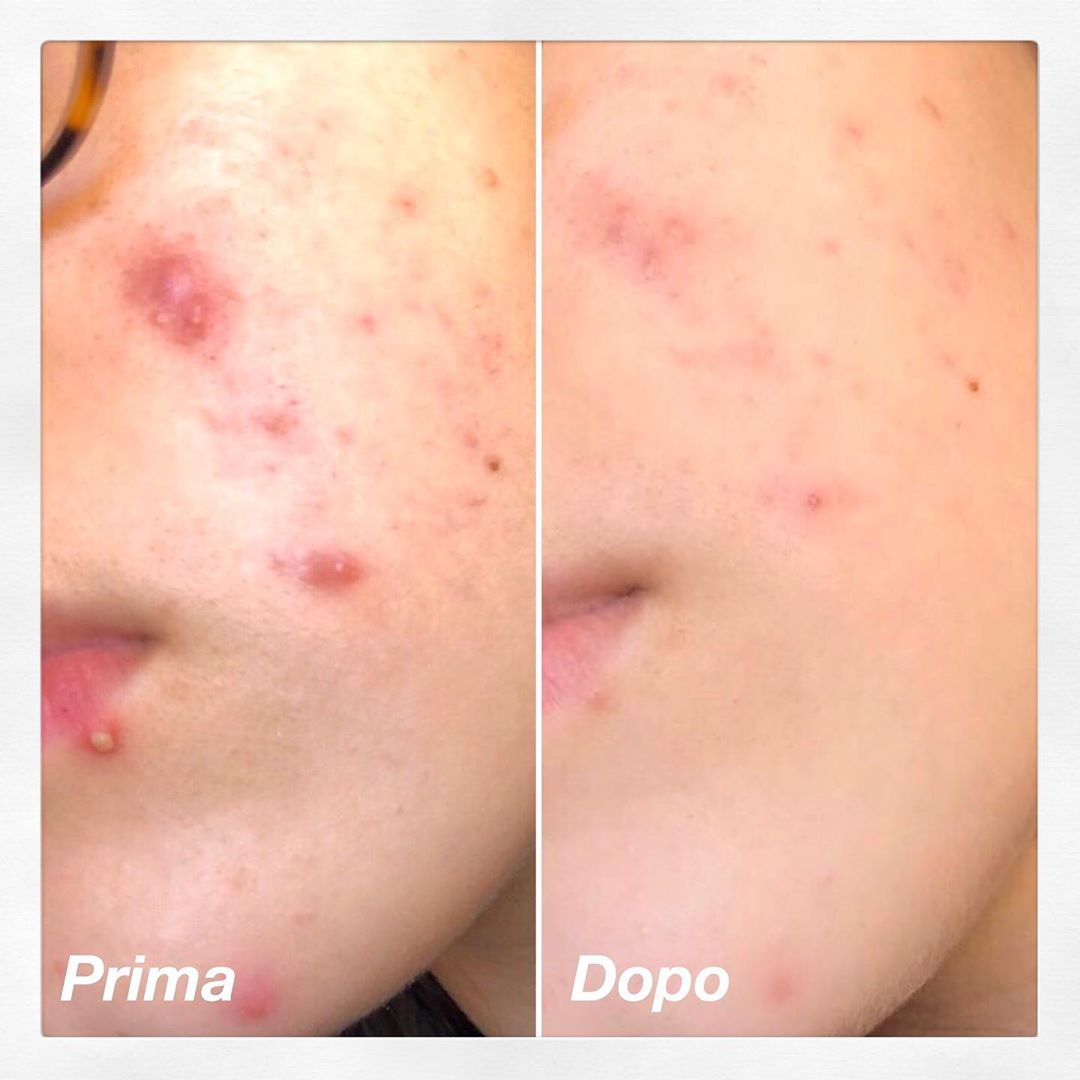 I risultati di SKIN FIRST®!✨
Nessun filtro.
Nessun make up.
Nessun ritocco.
Grazie per aver creduto nelle mie formule ❤️
👇👇👇
instagram.com/p/B6siGZzIC7o/
.
skinfirstcosmetics.it
.
.
.
#skinfirst #skinfirstcosmetics #cosmetici #teamskinfirst