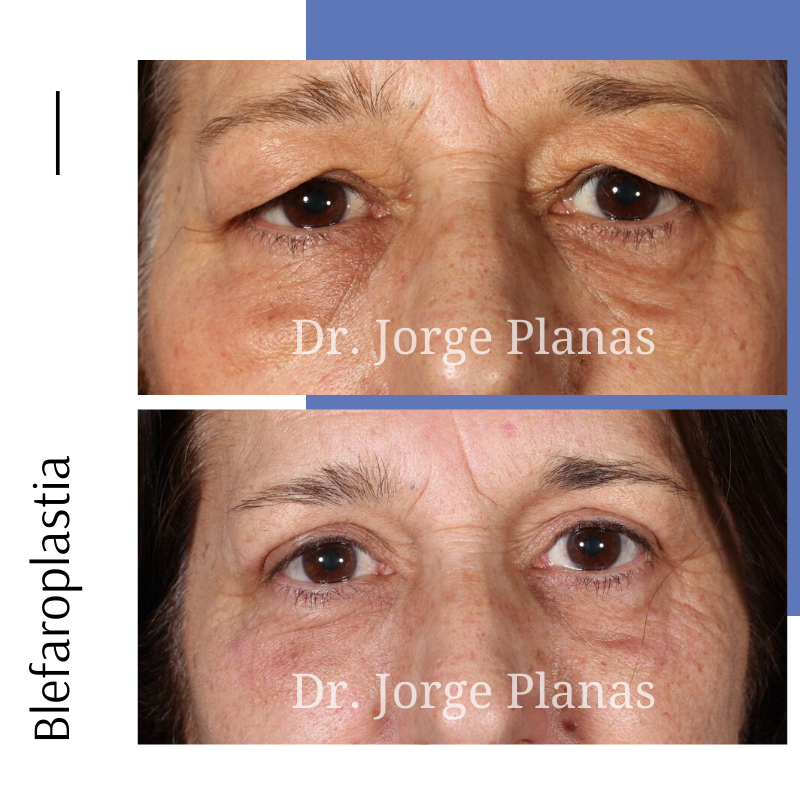 drjorgeplanas's tweet photo. Blefaroplastia superior e inferior, retirando exceso de piel y bolsas. 

Para conocer más casos como este os invito a seguirme en mi cuenta de Instagram ➡️ https://t.co/sBdFwFJf3O https://t.co/908UVGKN0C