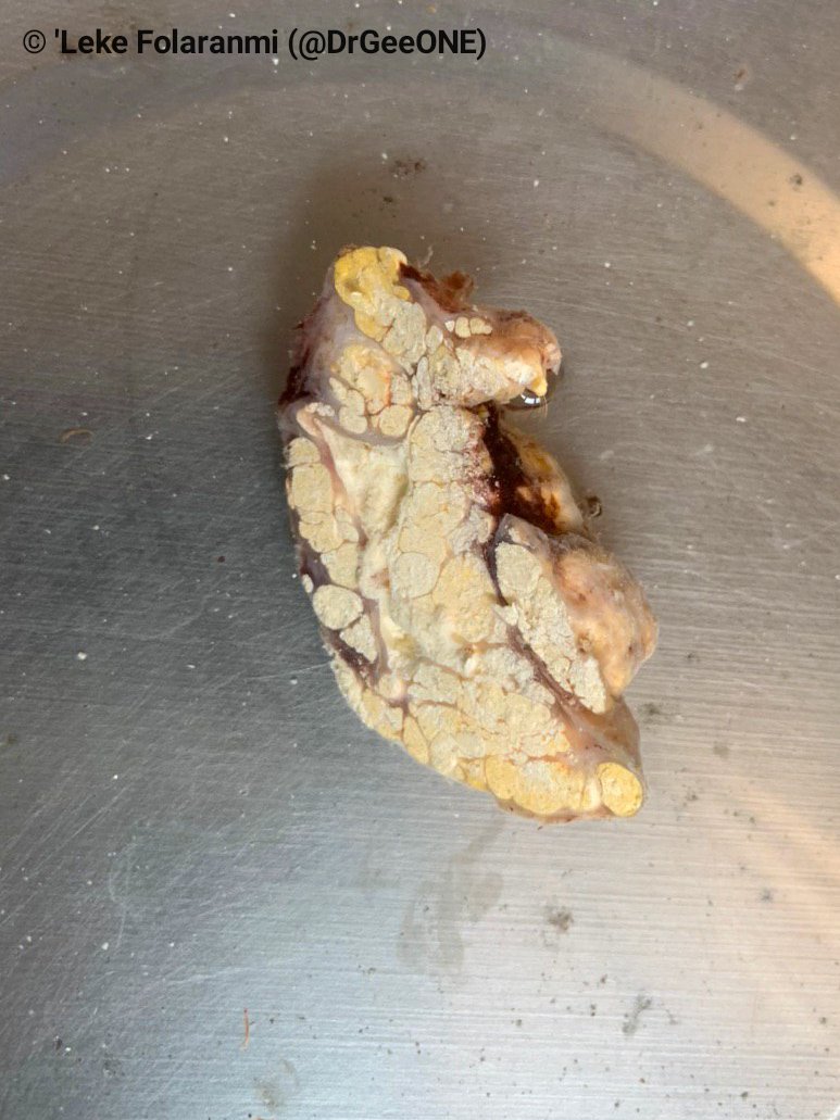 DrGeeONE's tweet photo. An elderly patient with elbow mass.
Gouty tophi
This is the first time I'm seeing preserved uric acid on H/E. Apparently, the lab is using non aqueous reagents! Beautiful.
Last pic: Polarizing microscopy.
@Halima81819652 @bjbanji
@smlungpathguy @JMGardnerMD
#BSTpath #Pathology https://t.co/d14RFcVE5C