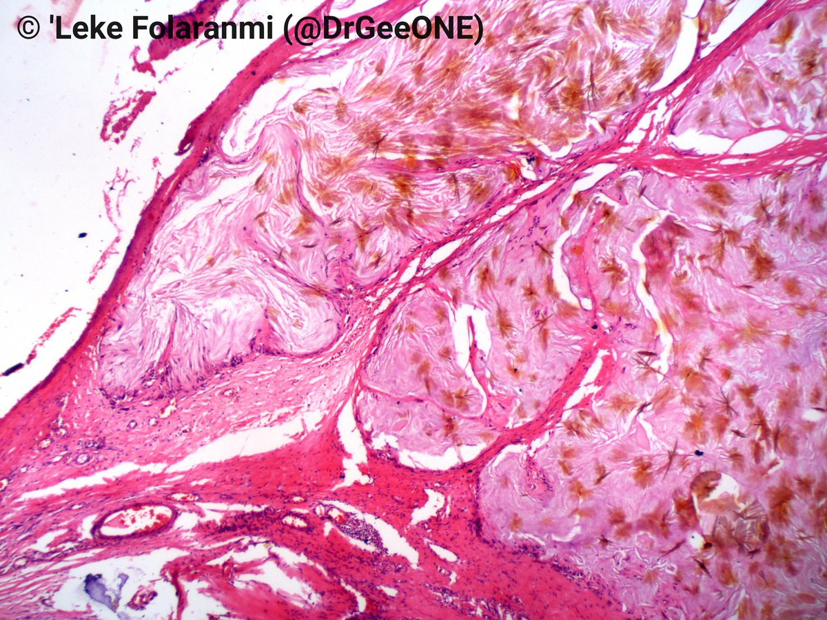 DrGeeONE's tweet photo. An elderly patient with elbow mass.
Gouty tophi
This is the first time I'm seeing preserved uric acid on H/E. Apparently, the lab is using non aqueous reagents! Beautiful.
Last pic: Polarizing microscopy.
@Halima81819652 @bjbanji
@smlungpathguy @JMGardnerMD
#BSTpath #Pathology https://t.co/d14RFcVE5C