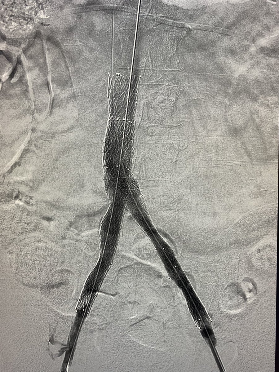 t_intheleadcoat's tweet photo. Another #optease #filter (dwell time 15 years )associated #IVC occlusion, treated with #Venovo #stents. #piecemeal #retrieval after breaking 2 #loopsnare #wires, 3 #alligator forceps and 4 #sheaths.Thanks @laronecampbell for great assist #irad @SIRspecialists @SIRRFS @JVIRmedia https://t.co/OLVdM6Bbql