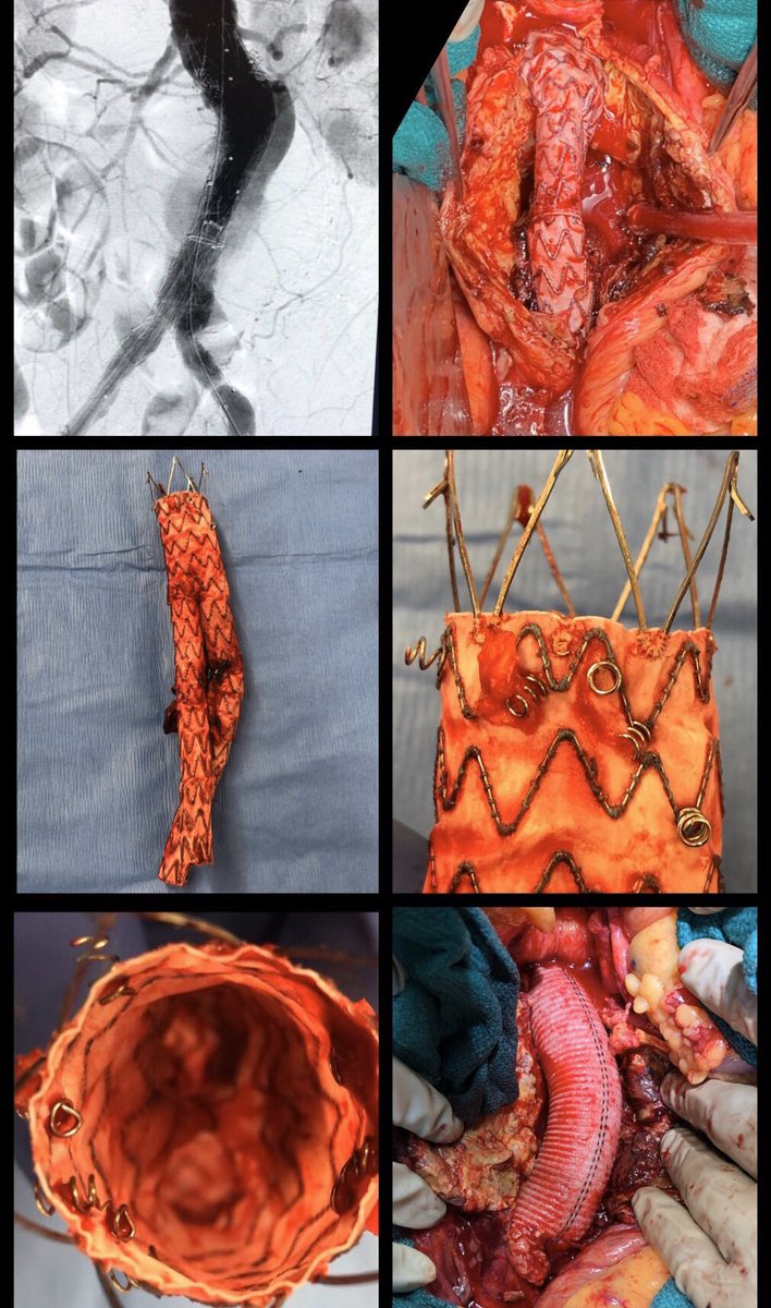 BruceTjadenMD's tweet photo. Persistent #Endoleak (Ia) after #EVAR + #endoanchors for contained #AAA #rupture. Treated w/ #explant & #OpenAAA #repair / #bypass. https://t.co/xKhlTtSXxO