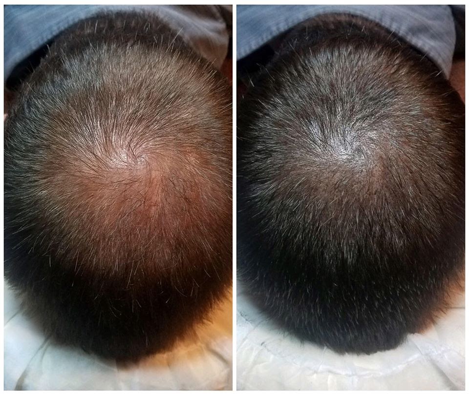 TheMensRoomSpa's tweet photo. Regain your confidence
Whether you have short or long hair, thinning hair or a visible scalp, SMP can provide the appearance of a thicker, fuller head of hair.
Available at The Men’s Room - Book your complimentary consultation today.
#mensroomspa #scalpmicropigmentation https://t.co/LZVf38LP1j