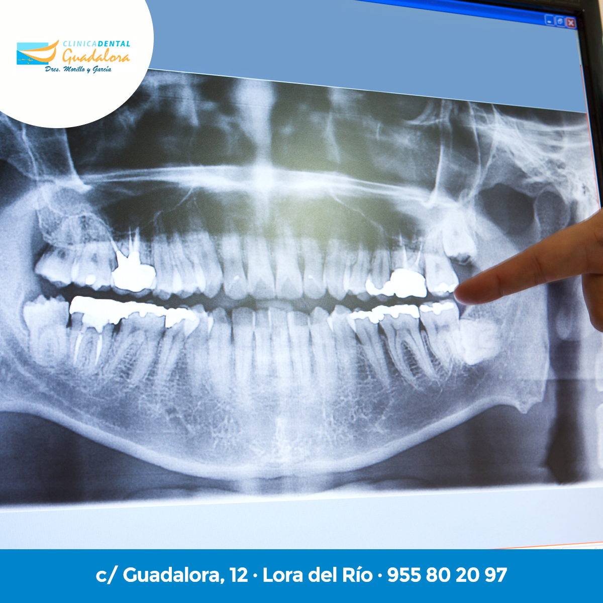 guadalora's tweet photo. ¿Sabes en qué estado de salud se encuentran tus dientes? ¿Sabes si las muelas de juicio tienen previsto aparecer? ¿Avánzate a cualquier enfermedad dental! En la Clínica Dental Guadalora contamos con la última tecnología en radiología dental. #radiologia #radiologiaguadalora https://t.co/R8eKfs8p1L
