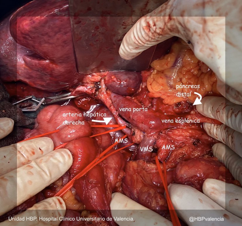 HBP_ClinicoValencia tweet media