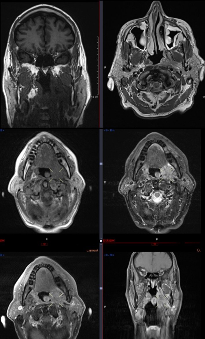 radiocyclist's tweet photo. Rousing myself from #twitterneglect.
Top 2 from MR TMJ. The left parapharyngeal space is obliterated but its edge of scan stuff.
Other 4 show the subsequent MR Neck. And the T4b N2c (AJCC7) disease 😲
#HNRad #MedEd #FOAMrad #FOAMed #radiology https://t.co/hniaFjnTAh