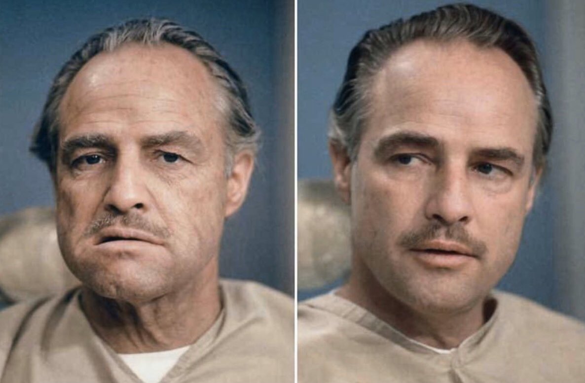 Yüz germe operasyonunu tercih eden erkeklerin %70’nin eşlerinden boşanmış dul erkekler olduğunu biliyor muydunuz?