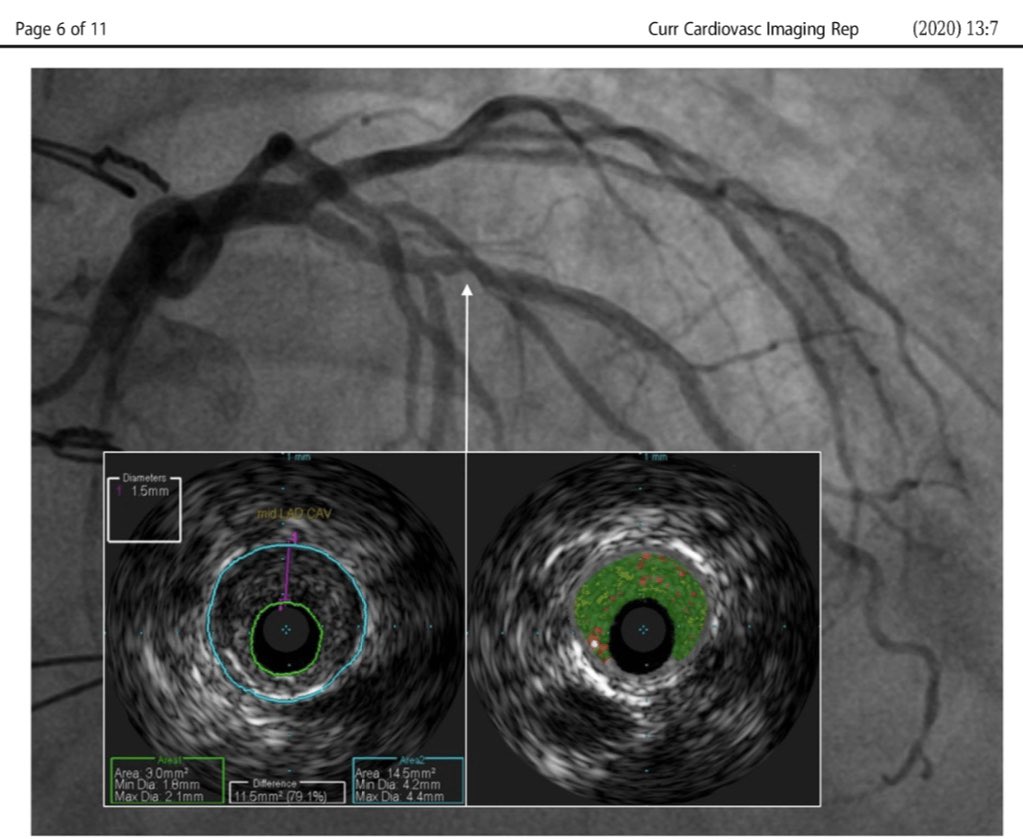 Sandeep Nathan, MD, MSc (@sandeepnathanmd) on Twitter photo Congrats to our <a href="/UCCardsFellows/">University of Chicago Cardiology Fellowship</a> <a href="/wali_e/">Eisha Wali</a> & <a href="/Linda_Lee_MD/">Linda Lee, MD</a> for an excellent review on intravascular imaging of CAV s/p OHTx: rdcu.be/b1cbW. Nicely done, guys! <a href="/NirUrielMD/">Nir Uriel, MD MSc</a> @AnnNguyenMD @benbowchung @JonGrinstein <a href="/agtruesdell/">Alex Truesdell</a> <a href="/SpringerCurRpts/">Current Reports</a> Congrats to our <a href="/UCCardsFellows/">University of Chicago Cardiology Fellowship</a> <a href="/wali_e/">Eisha Wali</a> & <a href="/Linda_Lee_MD/">Linda Lee, MD</a> for an excellent review on intravascular imaging of CAV s/p OHTx: rdcu.be/b1cbW. Nicely done, guys! <a href="/NirUrielMD/">Nir Uriel, MD MSc</a> @AnnNguyenMD @benbowchung @JonGrinstein <a href="/agtruesdell/">Alex Truesdell</a> <a href="/SpringerCurRpts/">Current Reports</a>