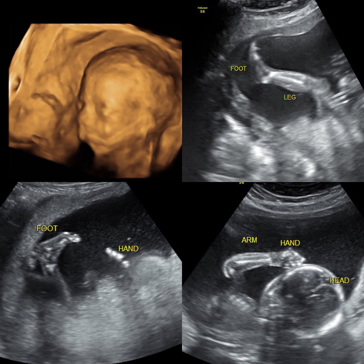 shelbslambert's tweet image. What a great day 💞 #halfway #anatomyscan