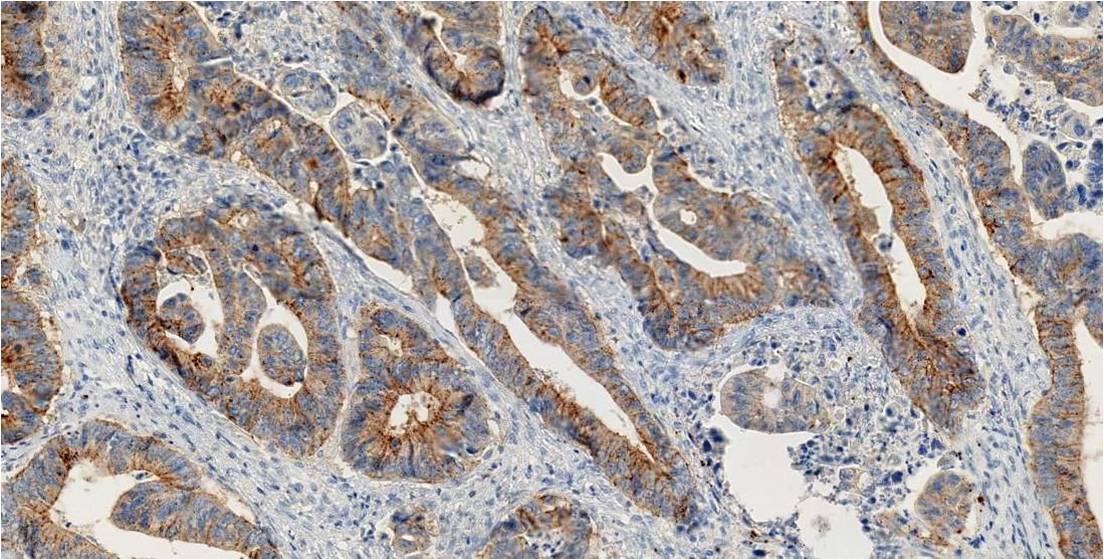 RaquelMartnHer2's tweet photo. NTRK Fusion Colorrectal carcinoma: 
male, 73 yo, with colorrectal adenocarcinoma. 
Pan-Trk immunohistochemistry is a sensitive and specific ancillary tool for detecting NTRK fusion. 
NGS confirm fusion TRIM33-NTRK1. 
Complete the case with FISH. https://t.co/tGNVsNwSVg