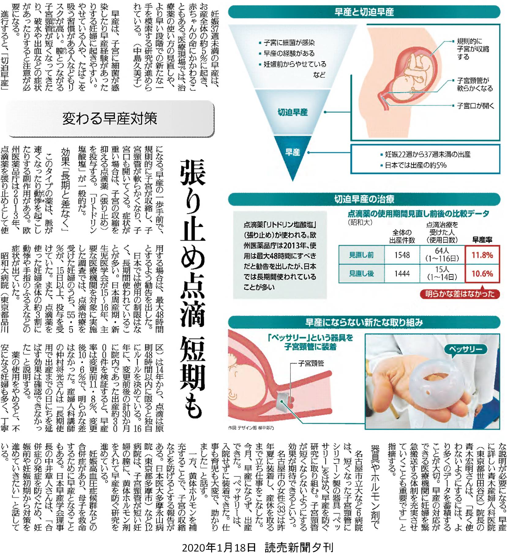 室月淳jun Murotsuki 出生前診断と選択的中絶のケア 発売 切迫早産妊婦にたいするリトドリンの48時間投与 ショートトコライシス と早産予防ペッサリーの使用についての読売の紹介記事です ほとんどの切迫早産妊婦には長期入院 安静臥床管理は不要