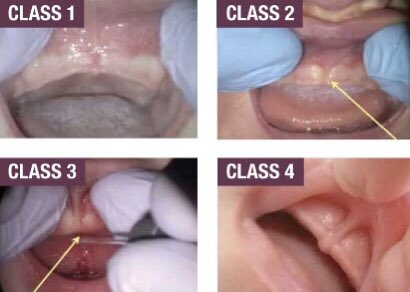 Mieja On Twitter Kalau Baby Tongue Tie Lip Tie Dia Akan Ada Masalah Nak Breastfeed Latching Dgn Cara Yg Betul Normally Baby Akan Rasa Tak Puas Bila Menyusu Https T Co Qaswst2tgy