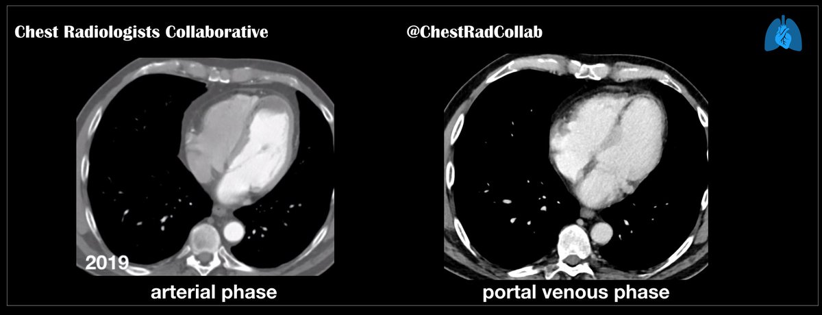 chestradcollab's tweet photo. @howardm19 @JeffreyKanneMD @howardm19

Yip, I would have diagnosed a LV thrombus, too.    :-)

But, the Case of the Disappearing Thrombus…on the portal venous phase. 

Nice, BL. 

(Case courtesy of DR. Thanks!) https://t.co/7161cVXeT8