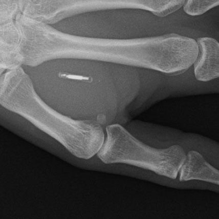 Henshaws's tweet photo. Do you pay using #contactless methods? Some people have taken it a stage further by having microchips implanted into their hand by a #biohacking firm in #Sweden (a #microchip the size of a grain of rice is implanted under the skin) Would you have it done..? #a11y #blind #BioTeq https://t.co/9ye9p8h7Ug