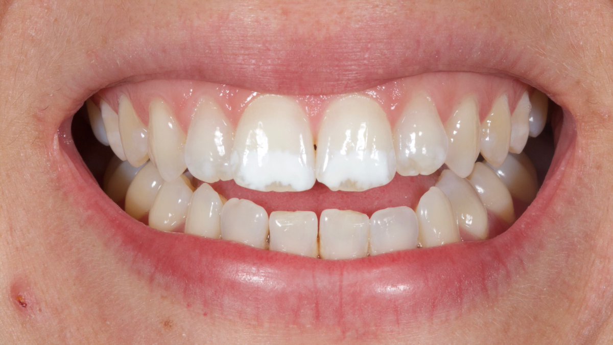 Dentistry's tweet photo. @DrRField discusses a minimally invasive treatment option for white spot lesions ⬇️

https://t.co/nfILt4hU9u

#aestheticdentistry #dentistry #fmc #dentalaesthetics #whitespots #whitespotlesions https://t.co/obCIFVp4Ey