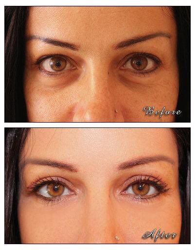 DemetriadesNeo's tweet photo. UPPER Blepharoplasty
Minimally invasive technique
Few days of recovery
Local anesthesia
Excellent Aesthetic Results
#cyprusfacialsurgery #facialcosmeticsurgery #oralandmaxillofacialsurgery 
#weloveyourfacemorethanyoudo
#DrNeophytosDemetriades
#blepharoplasty #eyelidsurgery https://t.co/W4M07EAFkz