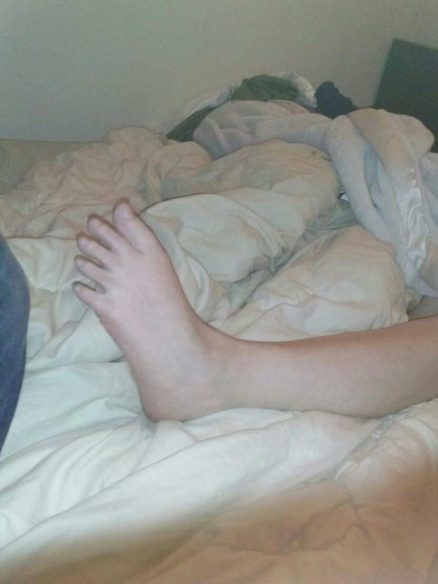 Side view of Amanda's left foot badly contorted due to a muscle spasm that locked her foot in place back in Jan 2013. The top of her foot is facing the outside and it's rotated 90 degrees