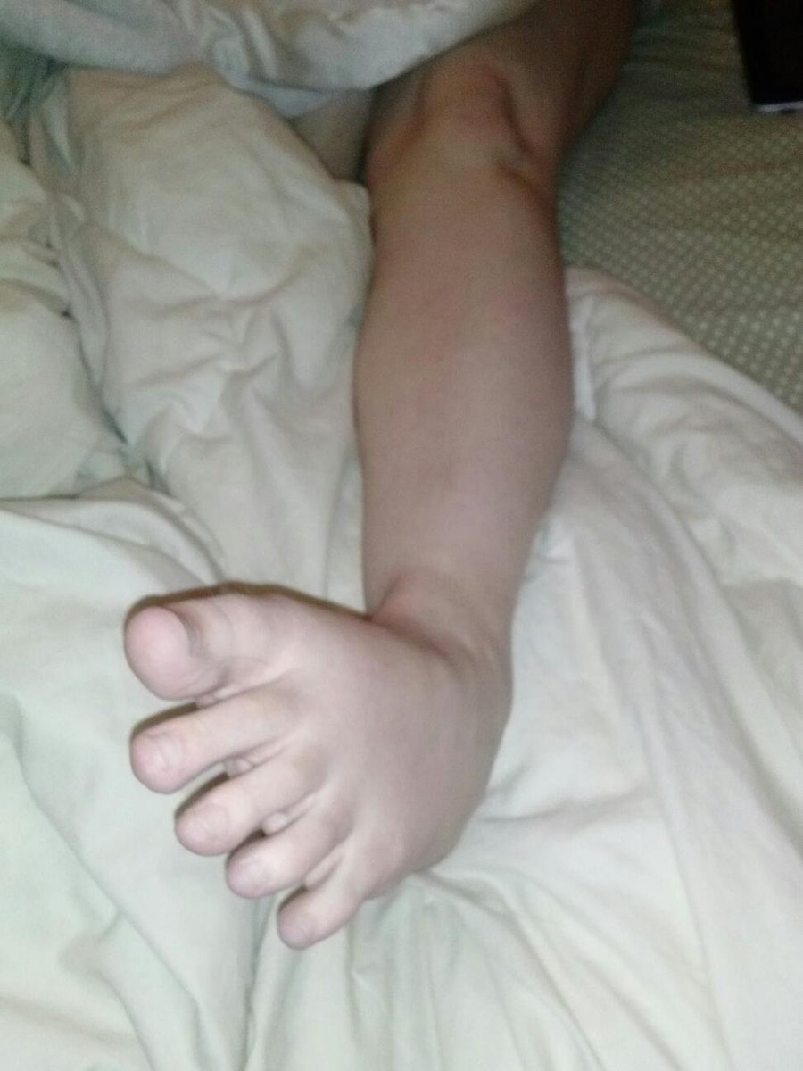 Front on view of Amanda's left foot contorted due to a muscle spasm that locked her foot in place. 