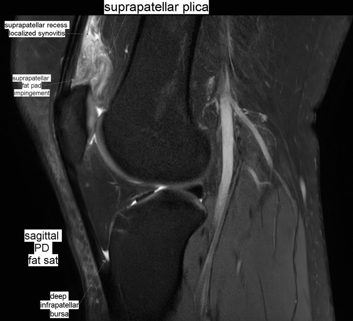 Above head and shoulder Resistant recorder Benoît Rizk on Twitter: "Patient with anterior knee pain. Localized  synovitis of suprapatellar recess and suprapatellar fat pad impingement  syndrome secondary to a suprapatellar plica: suprapatellar plica syndrome.  #MSKrad #knee #orthopaedics #radiology