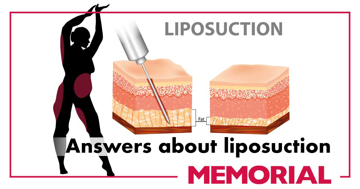 The concept of fat reduction and body countouring producedures vary based on patient’s requirements. The satisfaction rate of liposuction patients is based on long lasting results without any complications. 

#MemorialHospital #liposuction #fatremovalsurgery