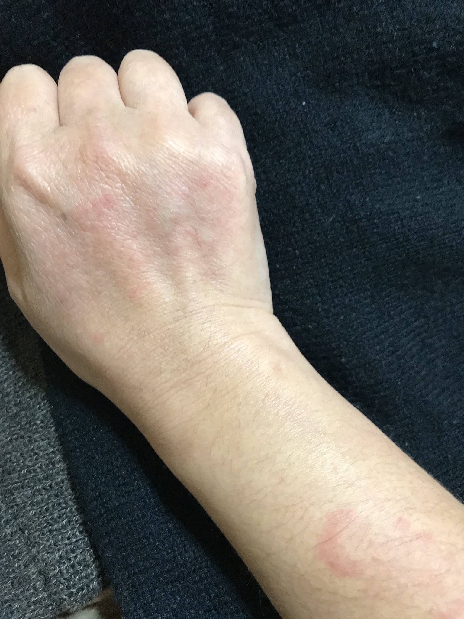 じろうず على تويتر 帰宅後やっぱり出ちゃう 右手はこれでも薄くなったところ 昼間はそれほどじゃなかったから 暗くなってからの寒暖差 の方が出やすいみたい 太ももなんかはかゆみもないから薬は効いてるはずなんだけどーーー 蕁麻疹 光線過敏 寒暖差アレルギー