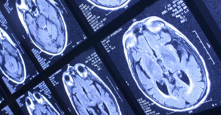 brain scan image
