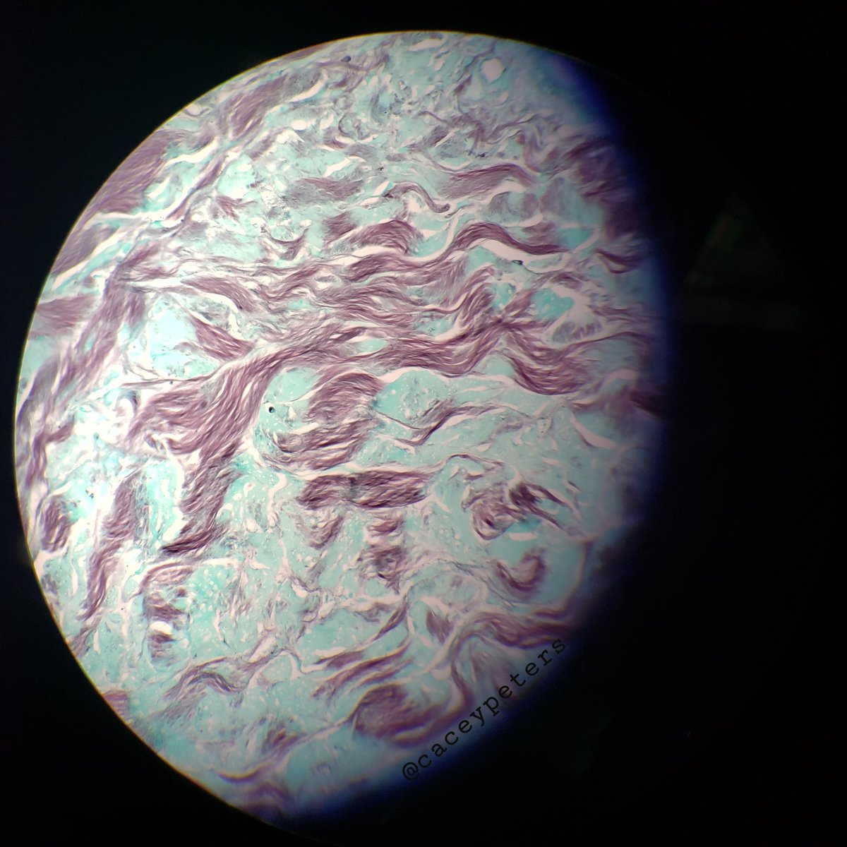 caceypeters's tweet photo. Planet Fibril
#pathplanet #pathology #dermpath #dermatology #pathart #histology #astronomy https://t.co/Sm6FcmalRA