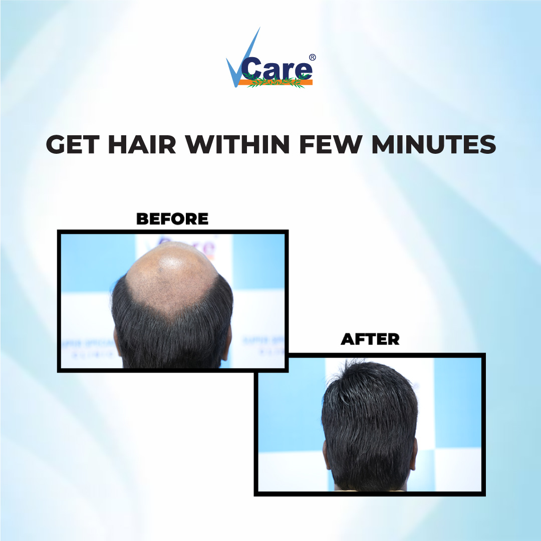 Hairlosssolution Hashtag On Twitter