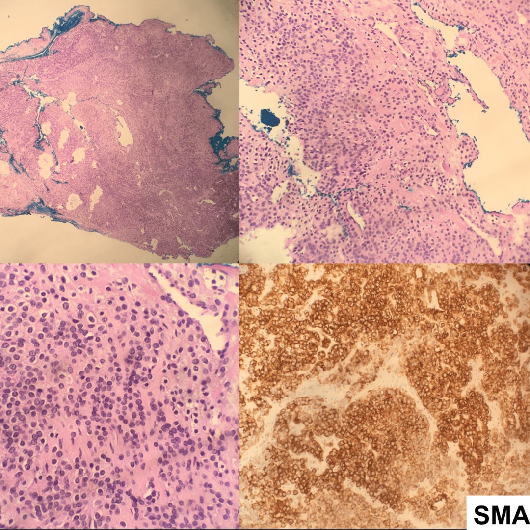 Glomus tumor. 11 yo F w/ R middle finger subungual lesion. Perivascular mesenchymal neoplasm composed of cells resembling modified smooth muscle cells of glomus body. Micro: Solid nests of round cells with punch-out nuclei with variably sized blood vessels. SMA, caldesmon pos