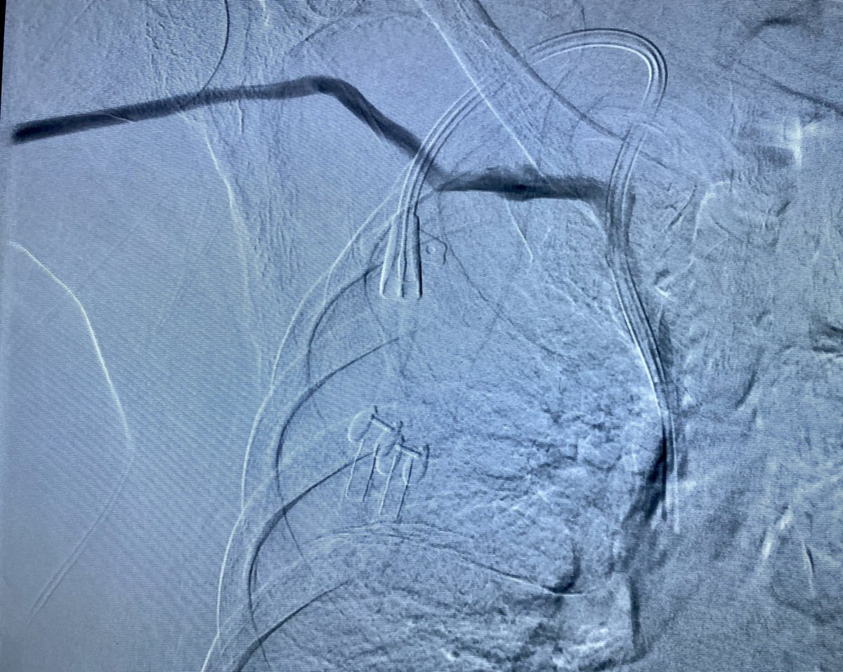 wasse_m's tweet photo. 👉🏽 Well, lookie what we have here!
Be a skeptic and do your own vessel mapping when referred pts with “no upper arm options” and multiple previous AV access surgeries.
@ASDINNews @RenalFellowNtwk
#BIGcephalic #ChartLore https://t.co/OslWrYTEIP