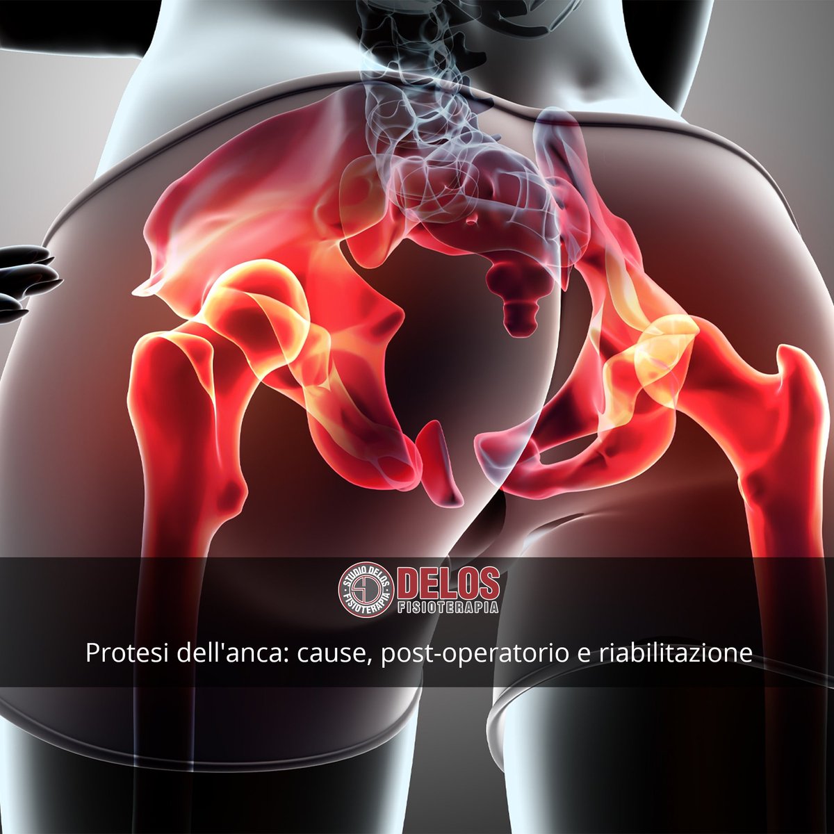 StudioDelos_fkt's tweet photo. Cosa è importante sapere dell'intervento di applicazione di una protesi dell'anca? Ecco tutte le informazioni su cause, operazione e riabilitazione.
#protesidanca
#riabilitazione https://t.co/IlQDyN4YC3 https://t.co/RirDAaDkXw