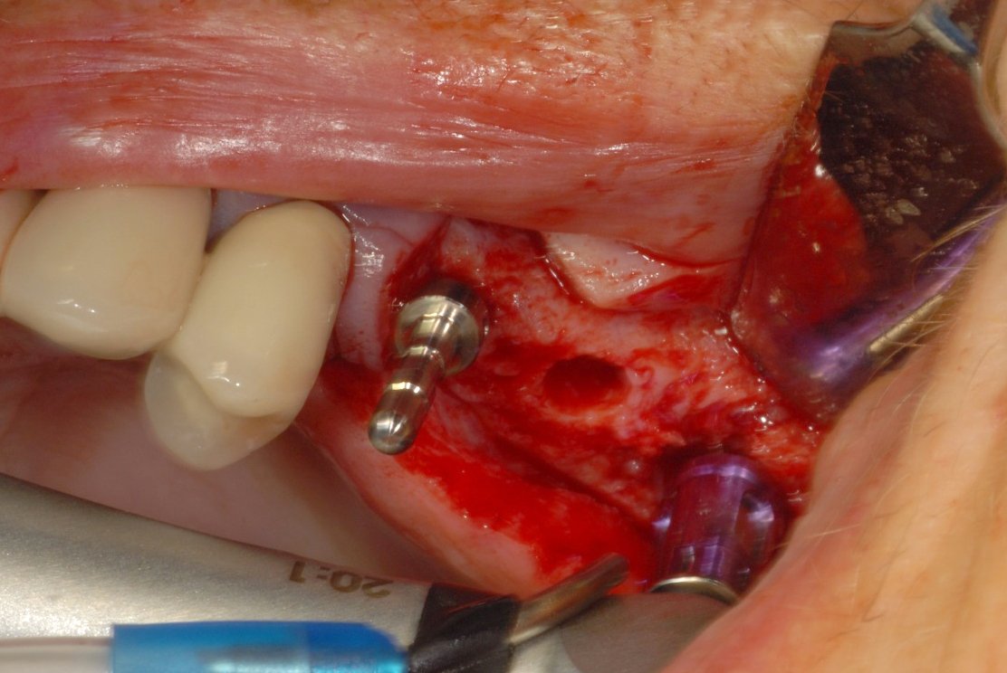 OsstemImplantUK's tweet photo. Not got yourself booked for the Sinus Lift Course with speaker, Dr Shushil Dattani at Kent Smile Studio in Chatham?🤔Food & refreshments included. Course fee:£495 Limited places-book now https://t.co/lyUzq3eaSV call Claire: 07739 758 966 #osstemuk #osstemcourses #sinusliftcourse https://t.co/TMmdPyRPtC