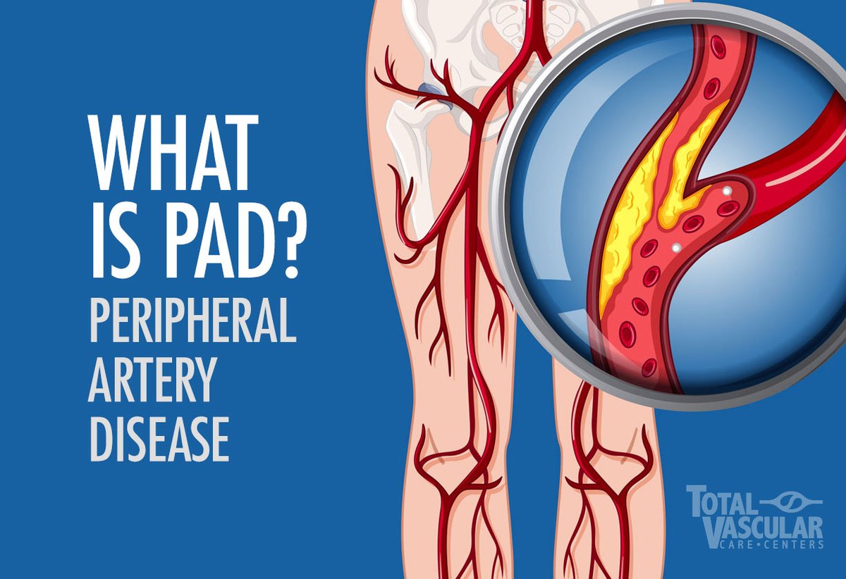 TotalVascularCC's tweet photo. What is PAD? (Peripheral Artery Disease)

PAD is a condition in which plaque, calcium &amp; other deposits collect on the interior walls of an artery. It is also known as atherosclerotic disease. It often occurs in the arteries, in the heart, and in the legs and neck.

#vascularcare https://t.co/gIwg5DMKwU