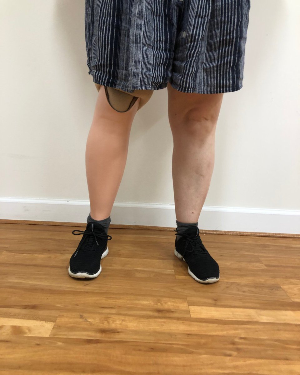 MedicalCenterOP's tweet photo. We're happy to help in any way to help customers maximize their potential. Sometimes, that means shaping and finishing a cosmetic cover just like the one in the photo so the prosthetic appears even more lifelike!
#moveforwardmcop #prosthetic #proshesis #cosmesis #oandp #mcop https://t.co/ikvqFQneH7