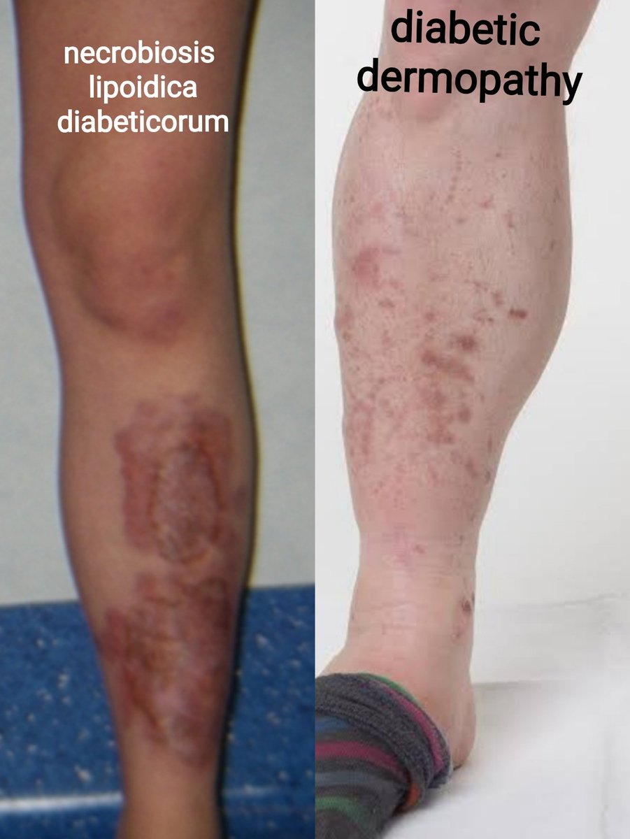 diabetic dermopathy vs necrobiosis lipoidica)