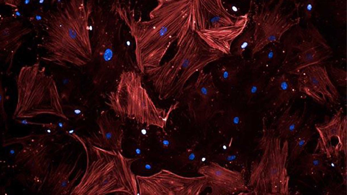 CR_UK's tweet photo. Scientists are looking at how they can target the cells around tumours to help prevent cancer spreading. Our latest Science Snaps has the story: https://t.co/CfSQvzSs9R https://t.co/n06QQns4tl