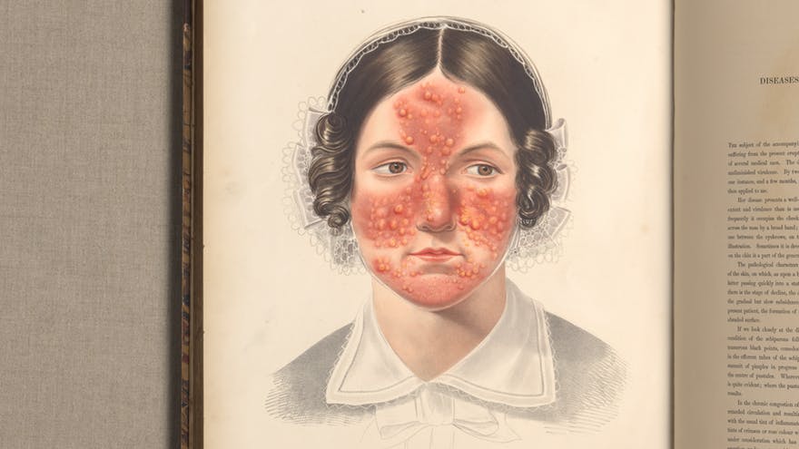 19th century illustration showing a woman with severe facial acne. 