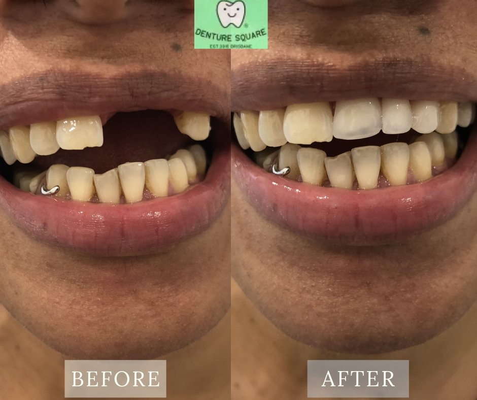 denturesquare's tweet photo. Contact Denture Square Brisbane, offer full upper and lower #denturerepair service to improve your #appearance and #health of your #mouth. Book your denture repair appointment today!
#dentureservicesBrisbane #fulldentures #dentureservice #dentist #permanentdentures #patients https://t.co/3ffmpFzytM