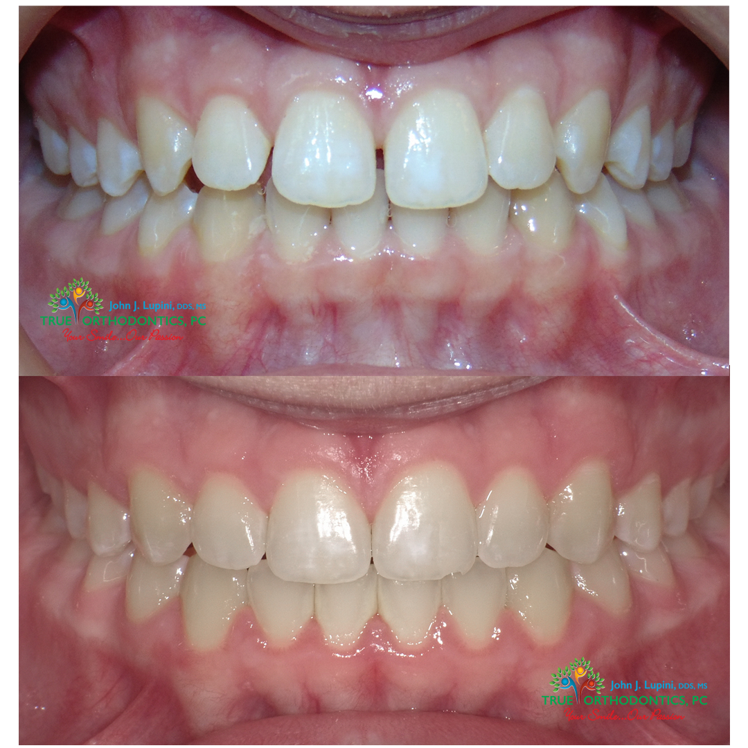 TrueOrthodontic's tweet photo. Check out Keegan's before and after. Keegan was a Class 2 Malocclusion. He had a 1mm diastema, 4mm overjet and a 5mm openbite. After wearing his elastics he now has that perfect smile. Looking great Keegan!
#TransformationTuesday #BestOrthodontist https://t.co/Rn2g6wJxYB