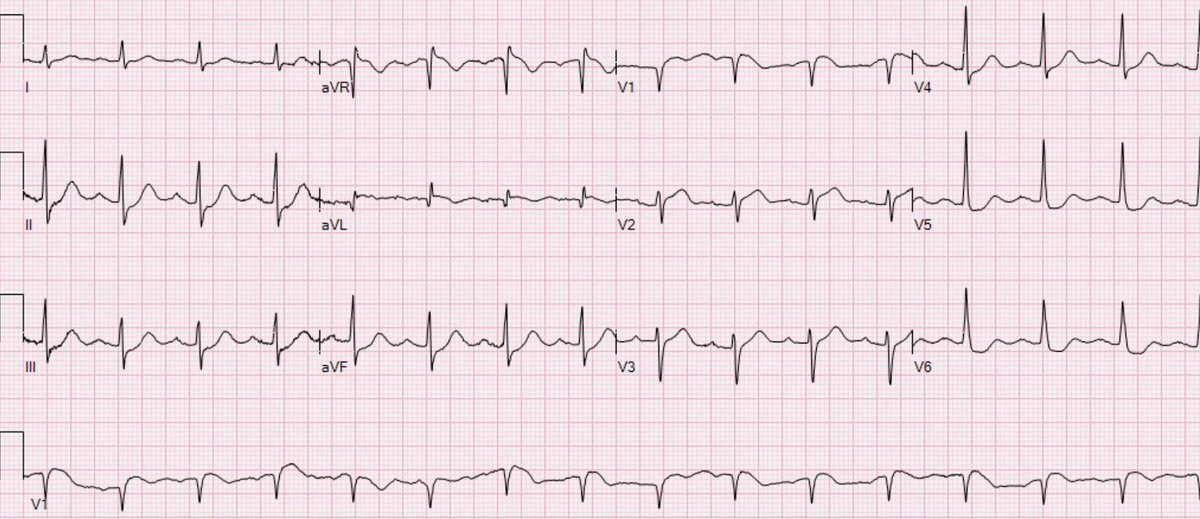 A man in his sixties with chest pain, tachypnea, and hypertension  hqmeded-ecg.blogspot.com/2020/02/a-man-…