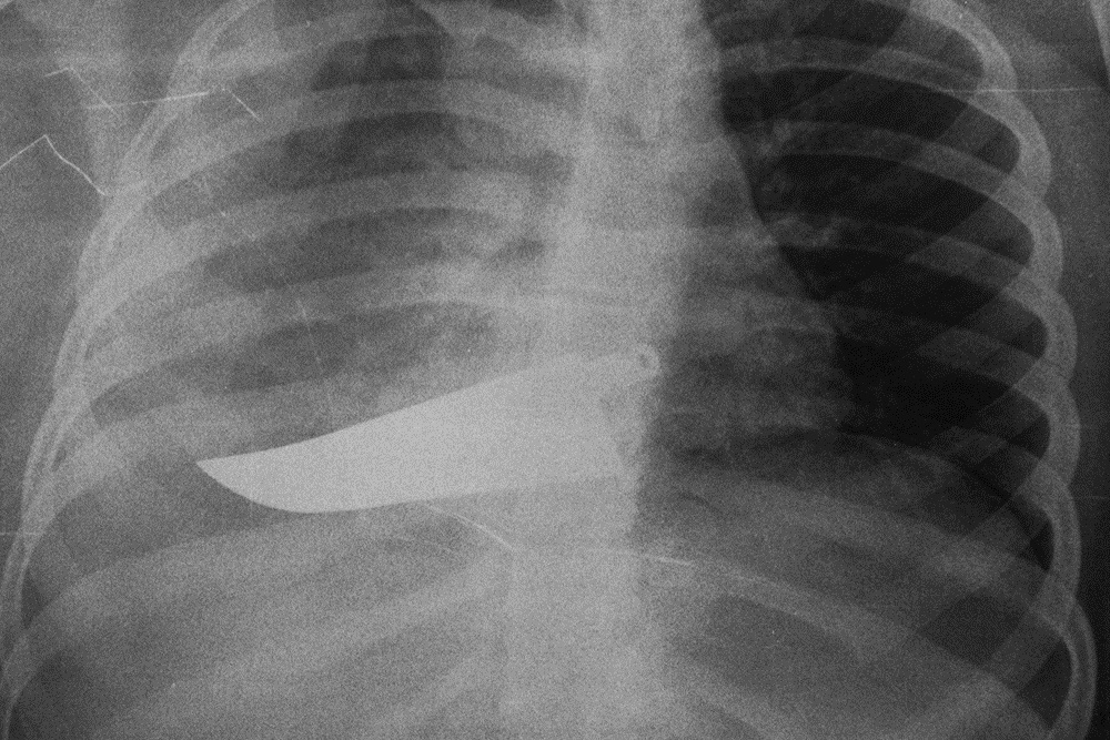 #violenzasulledonne "Abbiamo tentato di entrale nelle case e anche nel corpo delle #donne. La donna viene sempre rappresentata con il livido, con il sangue, ma ci sono anche altri tipi di violenza che solo una radiografia può mostrare" Marzia Bianchi
#mostra <a href="/WEGILTrastevere/">WEGIL</a>