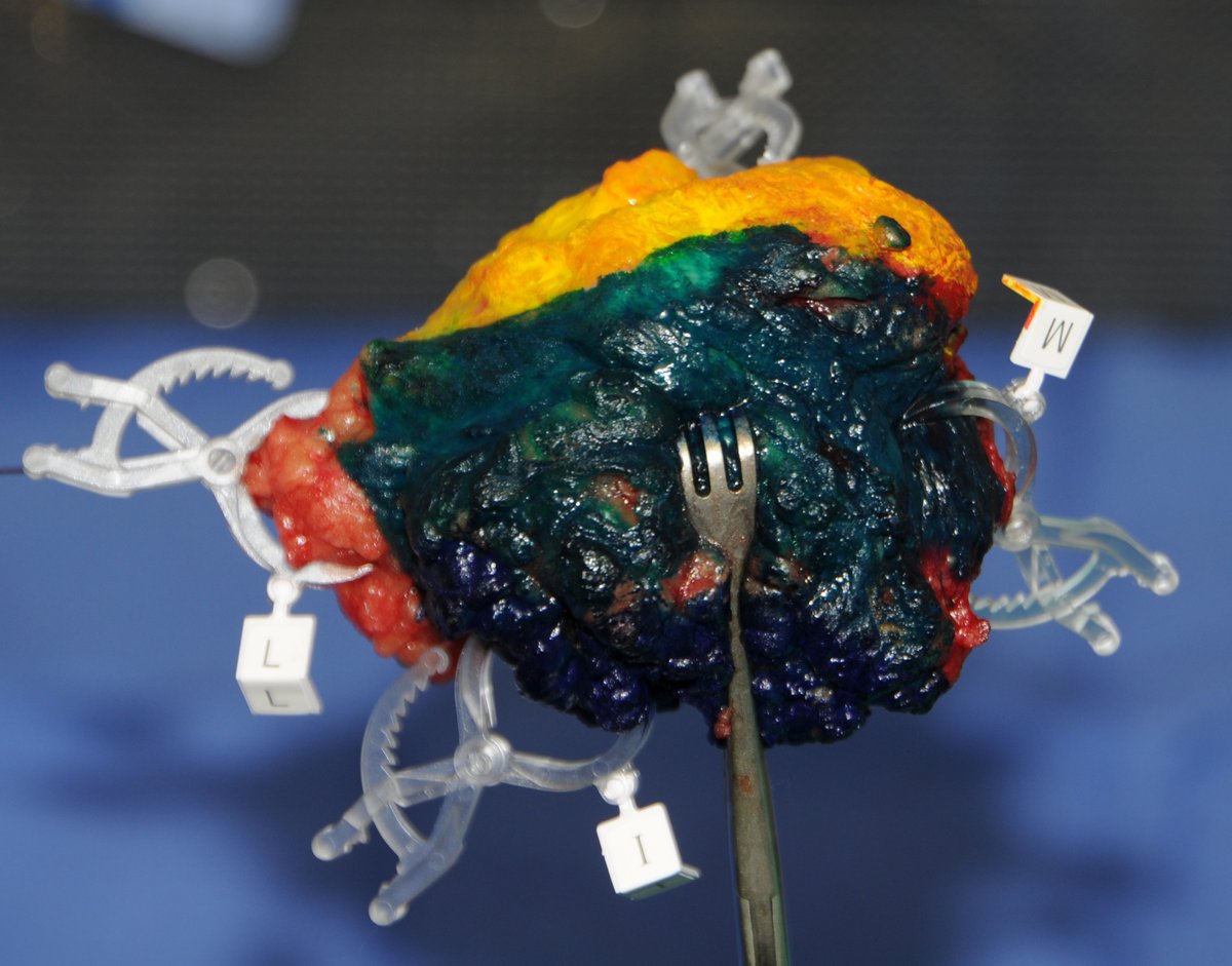 VectorSurgical's tweet image. Today is World Cancer day! Vector Surgical is committed to bettering cancer patients lives by reducing re-excisions and improving cosmesis. Learn more at vectorsurgical.com